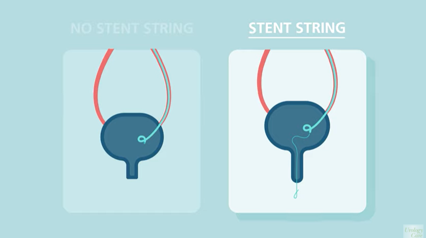 MUSICUrology's tweet photo. Looking for an educational video about ureteral stents? "Ureteral Stents: What You Need to Know" was developed in partnership with 
@UrologyCareFdn and is a great resource for patients. 

This video can be found at: https://t.co/eukejoxea8
#kidneystones #ROCKS #QualityImprovement https://t.co/QvzyGwMNSn