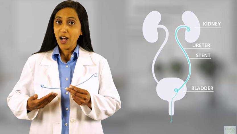 MUSIC Urology (@musicurology) on Twitter photo Looking for an educational video about ureteral stents? "Ureteral Stents: What You Need to Know" was developed in partnership with
<a href="/UrologyCareFdn/">Urology Care Foundation</a> and is a great resource for patients.
This video can be found at: MUSICurology.com/stent-video/
#kidneystones #ROCKS #QualityImprovement Looking for an educational video about ureteral stents? "Ureteral Stents: What You Need to Know" was developed in partnership with
<a href="/UrologyCareFdn/">Urology Care Foundation</a> and is a great resource for patients.
This video can be found at: MUSICurology.com/stent-video/
#kidneystones #ROCKS #QualityImprovement