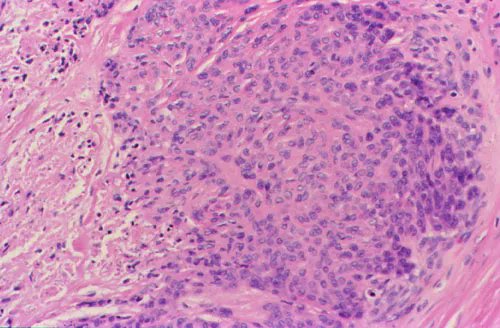 The most common sarcoma in the hand, epithelioid sarcoma, can mimic GA or rheumatoid nodule. Best screening test is pan-keratin, as ES always is +. INI1 while helpful may be retained in up to 10% of cases. I never like doing a "negative test" for screening. #BSTpath <a href="/CCFPathRes/">Cleveland Clinic Pathology Residency</a>