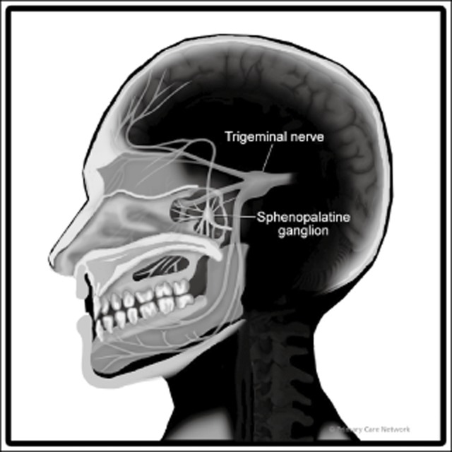 primneuromod's tweet photo. 📰 A double-blind, placebo-controlled study of repetitive transnasal sphenopalatine ganglion blockade with TX360® as acute treatment for chronic migraine

🔝 El bloqueo de SPG durante 6 semanas con el #Tx360® se muestra prometedor.

https://t.co/bHRwSwQmAr https://t.co/In5VBNaBiz