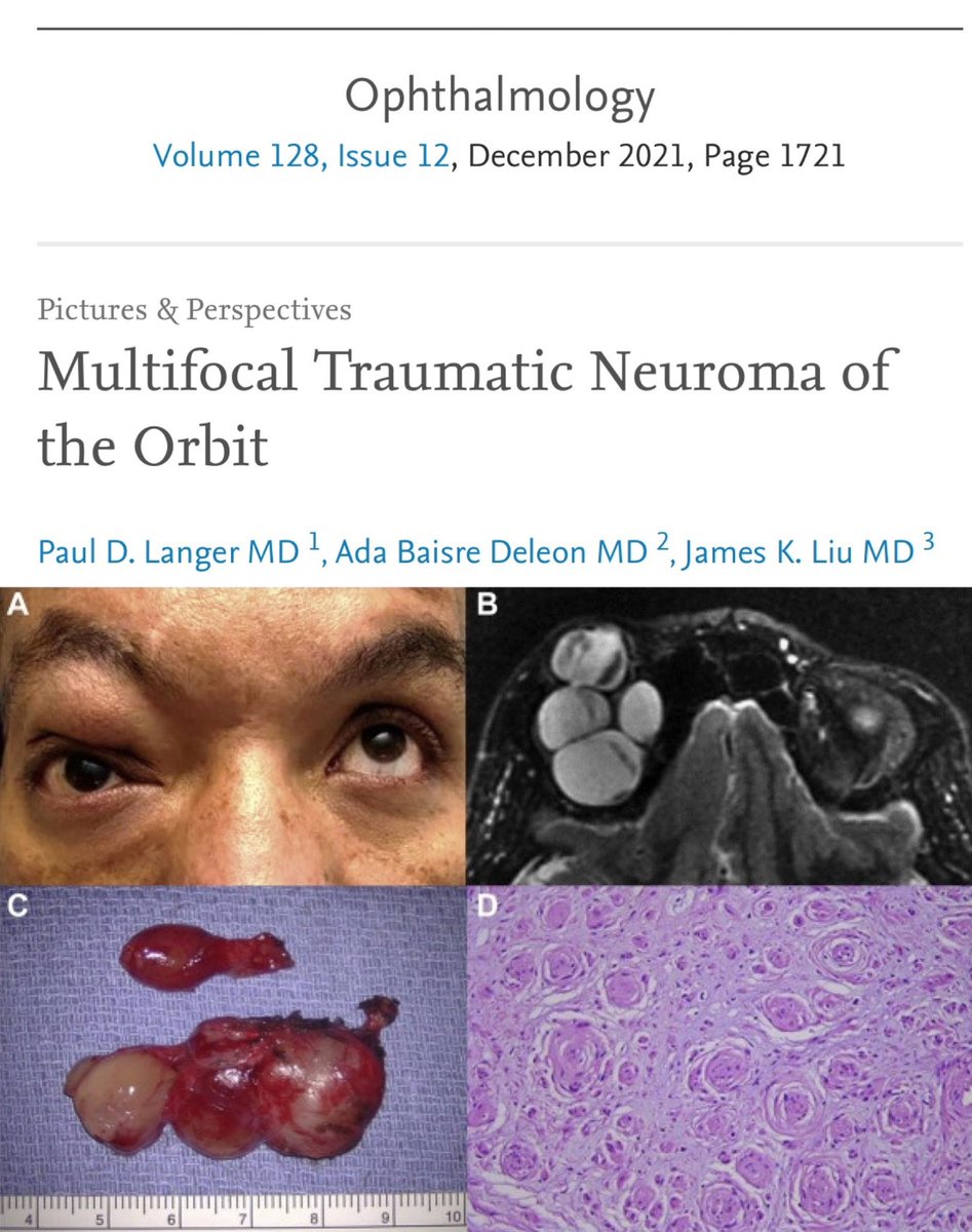 Rare orbital mass removed via eyebrow #keyhole craniotomy. Important for skull base #neurosurgeons to know #orbit. Blessed to work with great ophtho &amp; neuropath <a href="/BrainsSlicer/">Ada Baisre 🔪🧠🔬</a> team!

sciencedirect.com/science/articl…

#teamworkmakesthedreamwork <a href="/RUNeurosurgery/">Rutgers Neurosurgery</a> <a href="/CBMCNJ/">Cooperman Barnabas Medical Center</a> <a href="/NASBSorg/">NASBS</a>