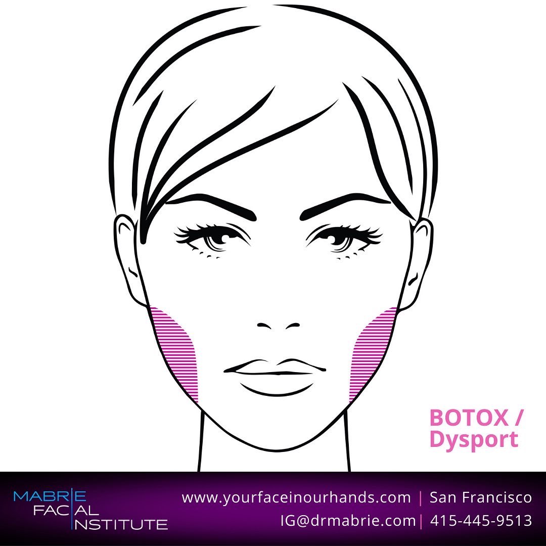 DavidMabrieMD's tweet photo. Did you know that you can change the shape of your face without surgery? Whether your face is too round, too square, or lacks definition, facial slimming with BOTOX can help you create or enhance your facial contours. https://t.co/qNJpGPg4cN