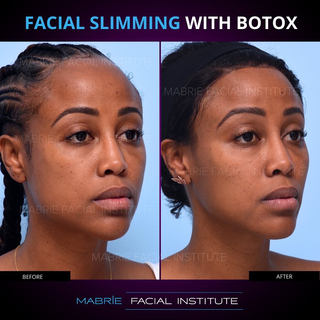 DavidMabrieMD's tweet photo. Did you know that you can change the shape of your face without surgery? Whether your face is too round, too square, or lacks definition, facial slimming with BOTOX can help you create or enhance your facial contours. https://t.co/qNJpGPg4cN