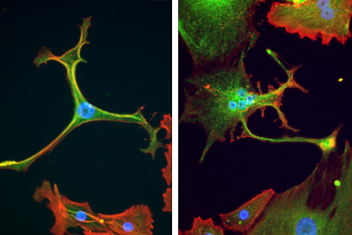 KiTZ_HD's tweet photo. #KiTZScience #Therapieresistenz von #Krebs überwinden: Knochen- und #Weichteiltumoren bei #Jugendlichen als Modellsystem 🔬🧪🧫 https://t.co/XacUoDojqN