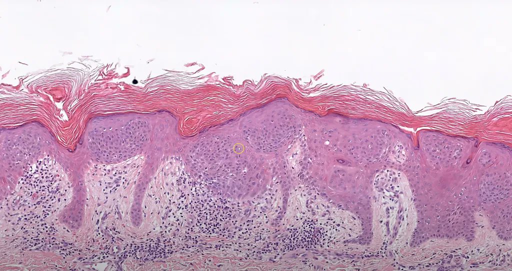 JMGardnerMD's tweet photo. One pic, no history. Your diagnosis? Answer here: https://t.co/0WxKjQMMgl. #pathology #pathologists #pathTwitter #dermpath #dermatology #dermatologia #dermtwitter https://t.co/e6NPmVnnBX
