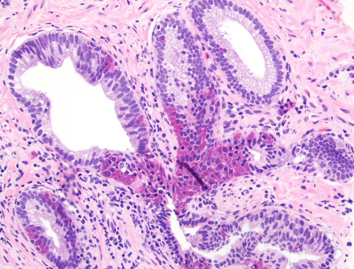 Great example of HGPIN with the so-called Paneth cell-like change #prostate #gupath @UMichPath #pathology