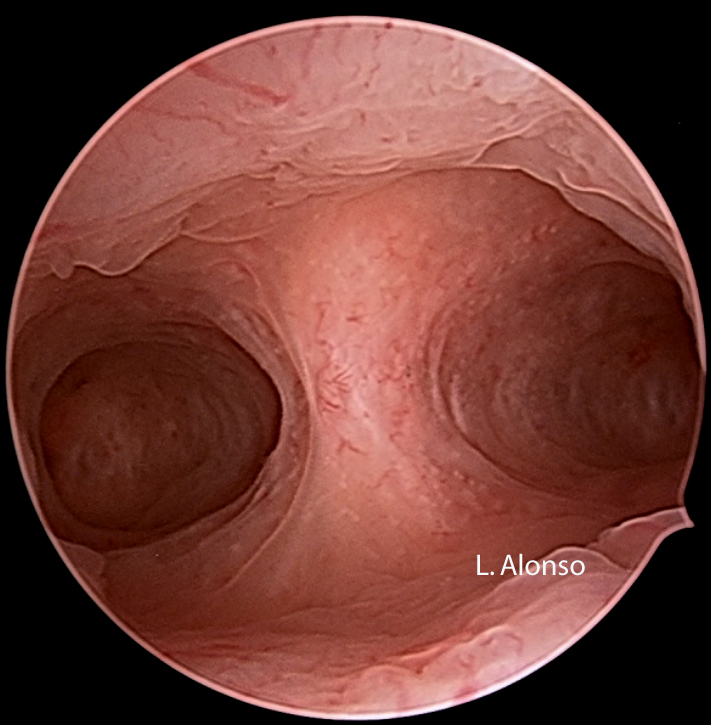 In a survey on women with untreated septate uterus (four studies between 1982 and 1997, Grimbizis et al. 2001), the authors have reported a mean 44.1% abortion rate, a mean 22.3% preterm delivery rate, a mean 32.9% term delivery rate and a mean 50% live birth rate.