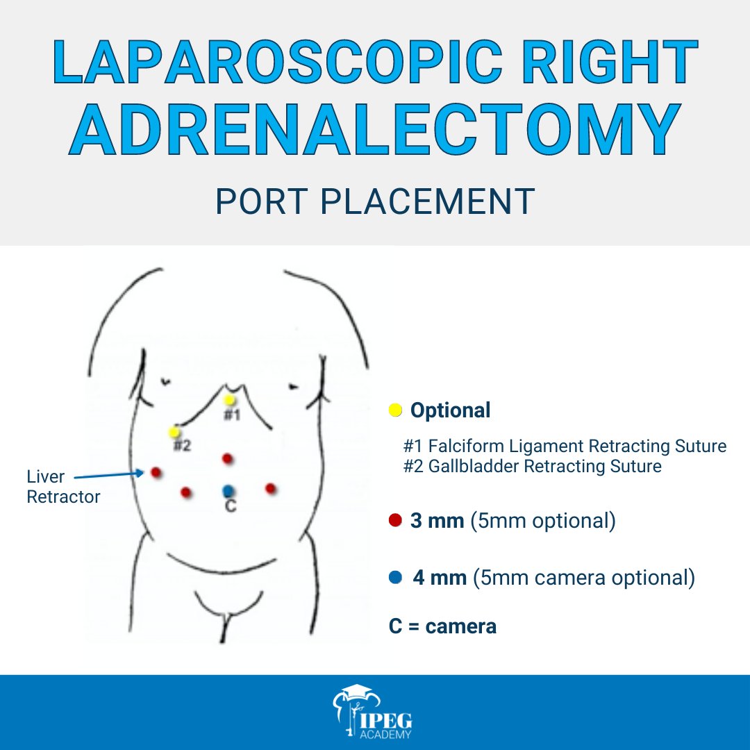 IPEG on X: Here is the port placement for a laparoscopic right  adrenalectomy! Did you know that all of our #IPEGAcademy instructional  videos include diagrams for the port placement? You can watch