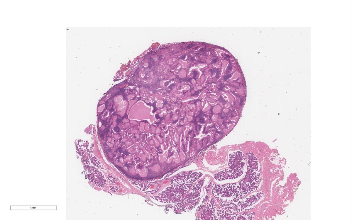 WeinrebIlan's tweet photo. Warthin tumour with a stowaway…

What is it? https://t.co/3FfmJ1KgMM