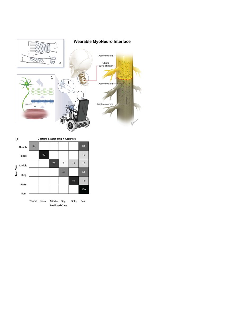 JNeurophysiol's tweet image. #ArticlesinPress - &quot;Sensing and decoding the neural drive to paralyzed muscles during attempted movements of a person with tetraplegia using a sleeve array&quot;
Jordyn E Ting, et al.
#EMG #Motorunit #Neuroscience
@dougweberlab @AlecsDelVecchio @PittTweet 
ow.ly/mT6550GQcO5