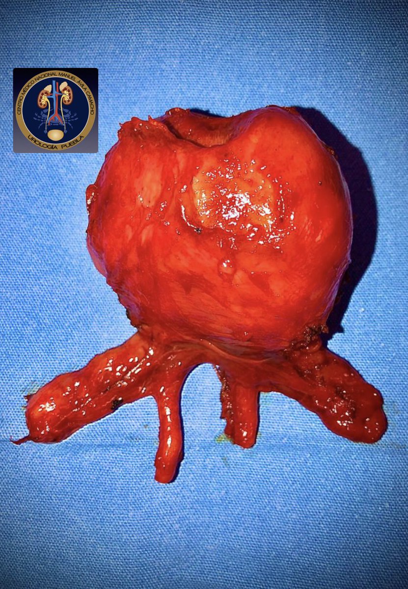 umaemac's tweet photo. Prostatectomía radical + linfadenectomía pélvica bilateral con neuropreservación en cáncer de próstata localizado. 
Nótese nódulo prostático tumoral.
#ProstateCancer #UroSoMe #UroOnco #Movember  @urovictore @Rocktor_Uro @Alejandro_Agc @ElvisSaguilan https://t.co/h0nwoZpqWQ