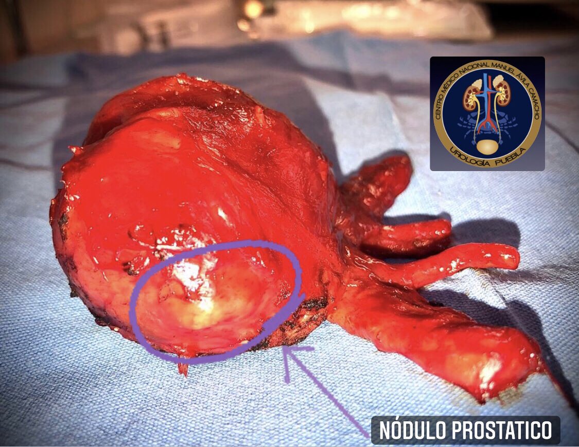 umaemac's tweet photo. Prostatectomía radical + linfadenectomía pélvica bilateral con neuropreservación en cáncer de próstata localizado. 
Nótese nódulo prostático tumoral.
#ProstateCancer #UroSoMe #UroOnco #Movember  @urovictore @Rocktor_Uro @Alejandro_Agc @ElvisSaguilan https://t.co/h0nwoZpqWQ