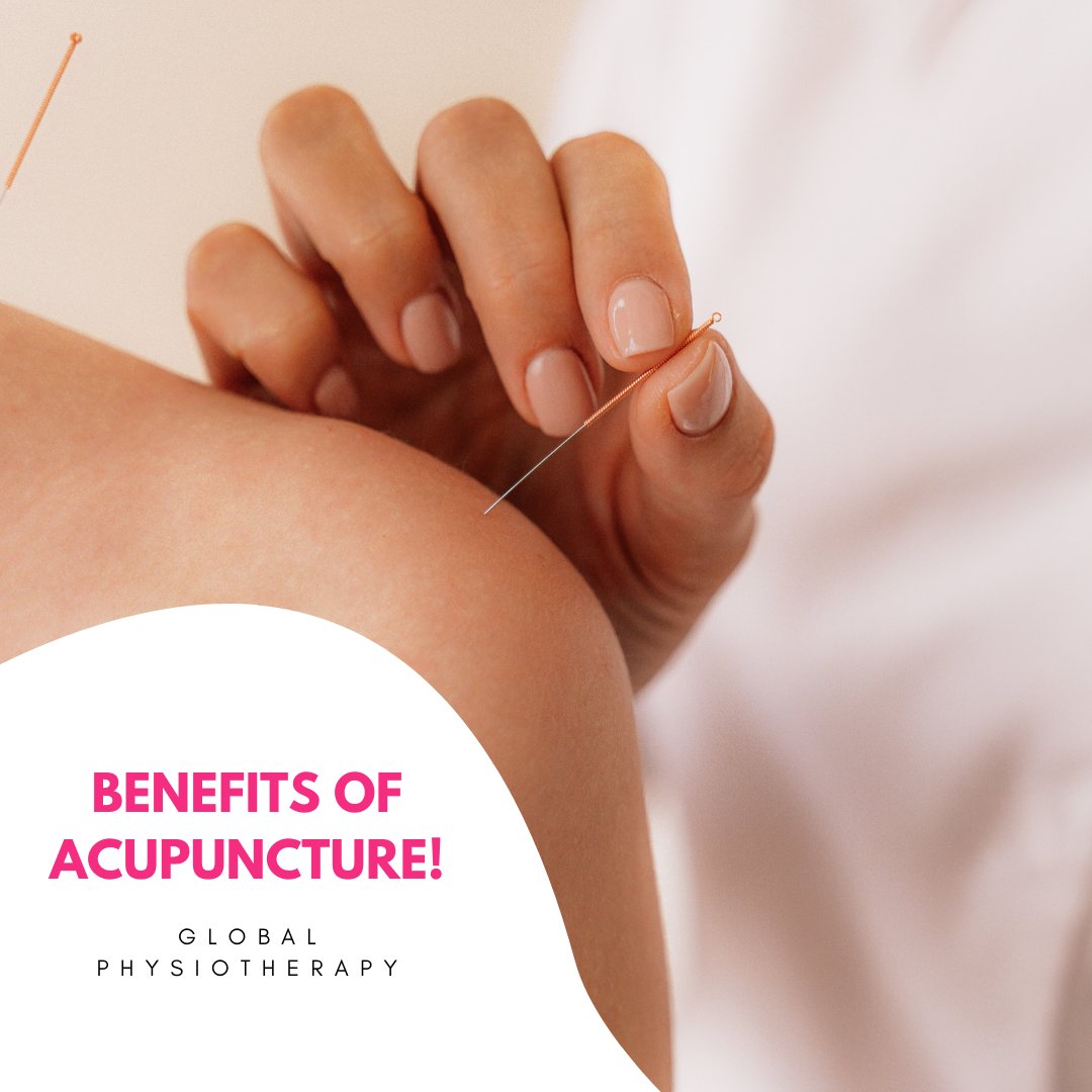 Health_Local's tweet photo. What are the 4 benefits of acupuncture? Read this article by Global Physiotherapy here: https://t.co/nzIv1umuE1

#physiotherapist #alberta #sherwoodpark https://t.co/8LKSKkbG7D