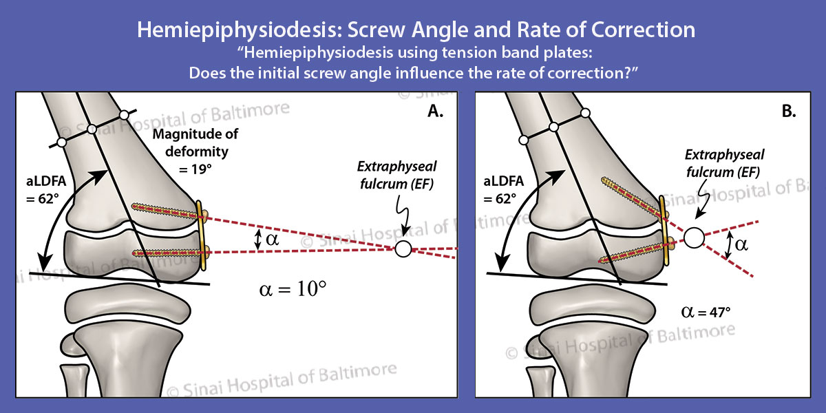 LimbLengthMD's tweet photo. Art with Joy! Joy worked with #ICLLFellow Dr. Hady Eltayeby & #DrHerzenberg on this art for a #hemiepiphysiodesis article coauthored by Dr. Christopher Iobst & published in the Journal of Children’s Orthopaedics in 2019. See findings at: https://t.co/HHMZ6fj5WT https://t.co/H1dCwHKuni