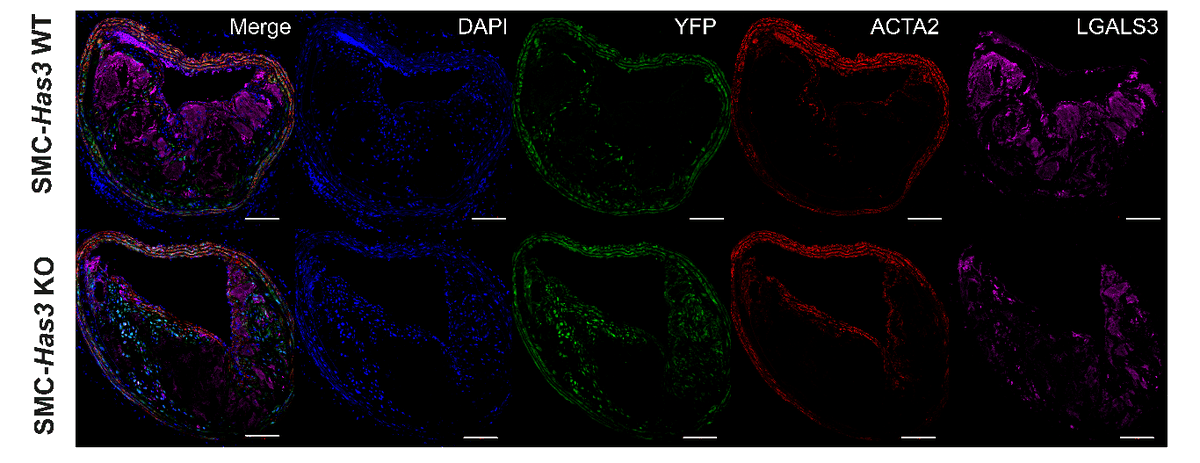 CircRes's tweet photo. Hartmann &amp; colleagues found the #hyaluronan matrix controls #collagen deposition by modulated #SmoothMuscleCell phenotype transition and plaque stability. Learn more about #atherosclerosis lesion stability at https://t.co/t1PZKAUEYw 

@danieljgorski @aacnewman13 @HHU_de https://t.co/60z1I9dYme