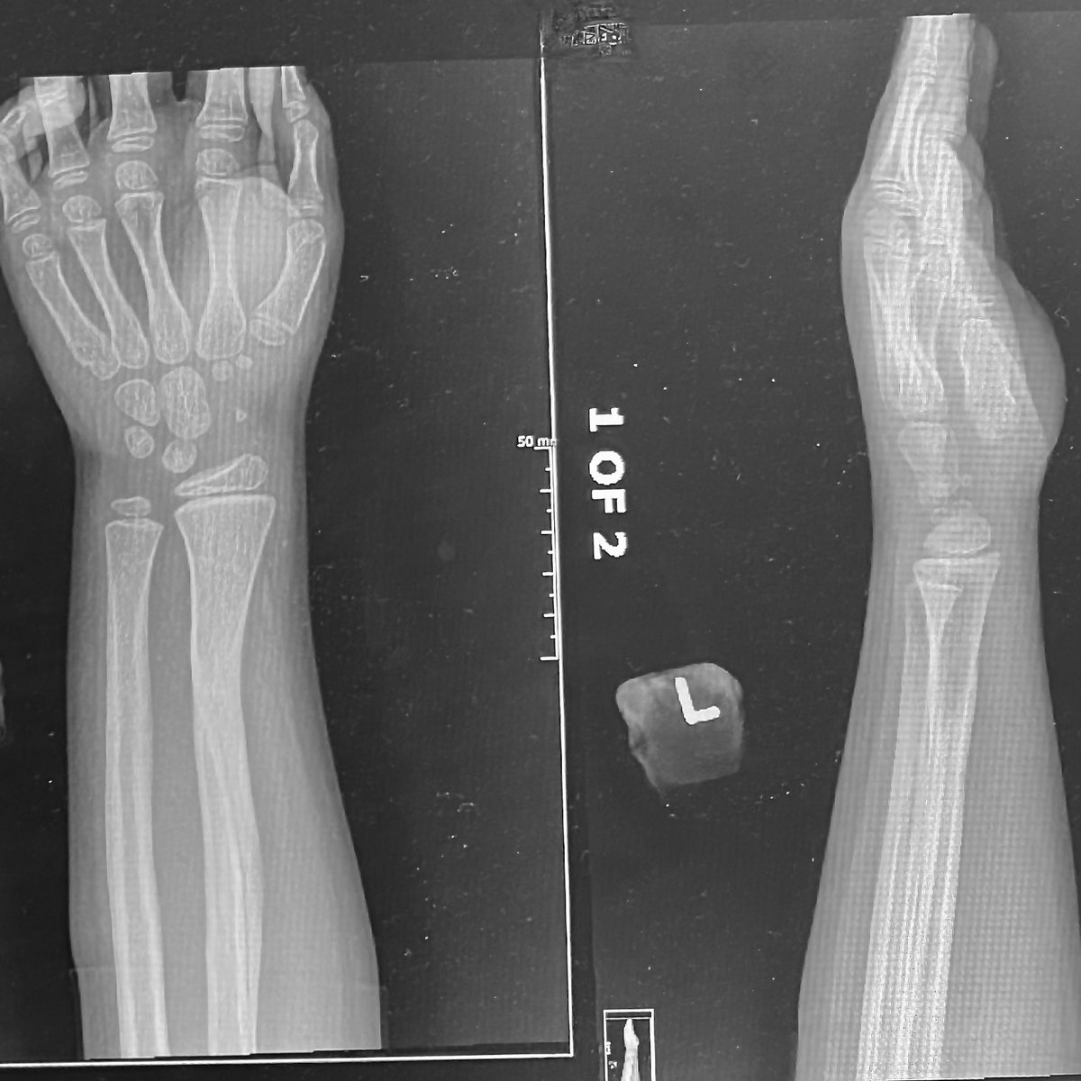 Another one for the Bennett Book, <a href="/Davembmd/">dave</a>

6yo distal radius fx. Was told surgery needed after reduction lost. 

Almost completely remodeled less than a year post injury.