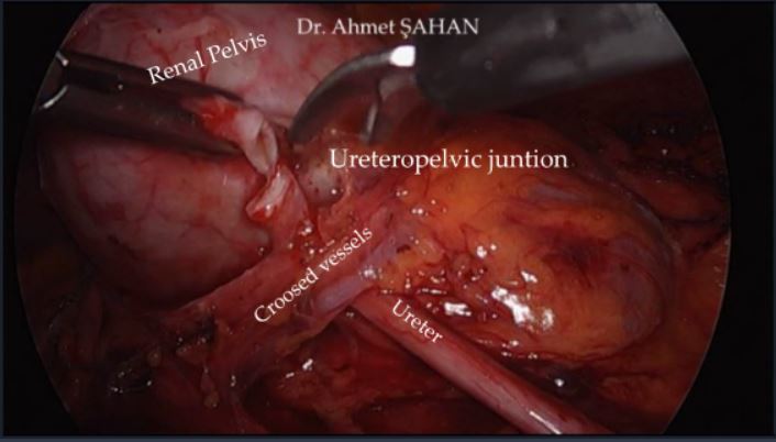 Laparoscopic Left Anderson Hynes Pyeloplasty 

Full video👉 youtu.be/1D0IHz4qDjM 

<a href="/KartalUroloji/">KARTAL ÜROLOJİ</a> <a href="/Orkunt8/">Orkunt özkaptan</a> <a href="/CubukAlkan/">Alkan Çubuk</a> <a href="/MgeYalg/">müge yalgı</a> 

#urology #laparoscopy #pyeloplasty