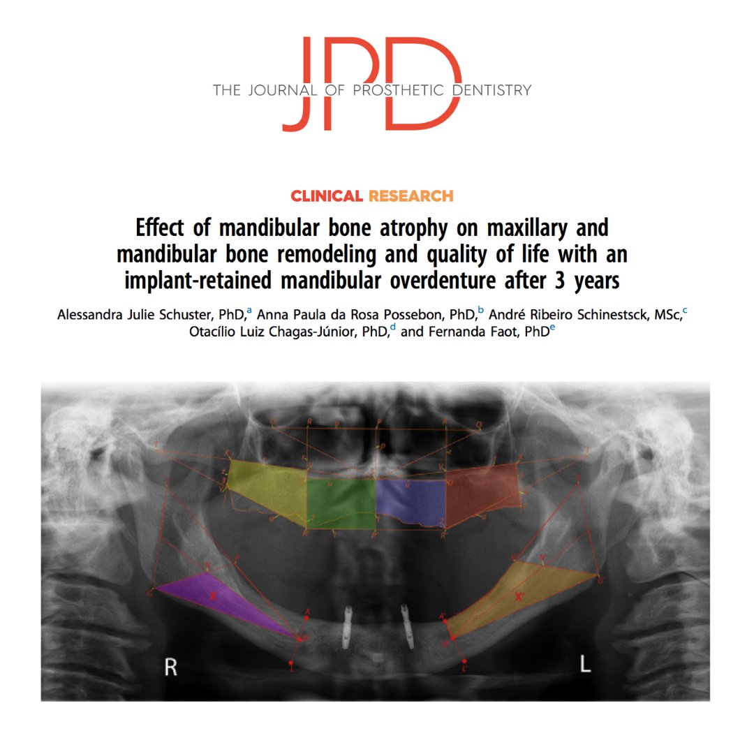 JPDentistry's tweet photo. This study evaluates #boneresorption patterns over time in patients with and without ridge #atrophy when wearing maxillary #completedentures and mandibular #overdentures and how this impacts #qualityoflife and #oralfunction. 

Learn more: https://t.co/kztGUEC2oU https://t.co/a0rvSVbPVN