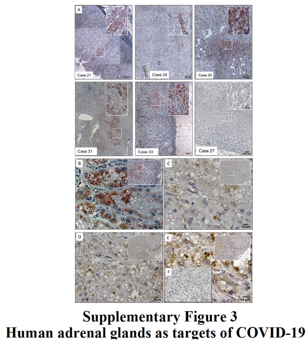 EricTopol's tweet photo. The list of organs that Covid can target keeps getting longer. Now the adrenal glands.
https://t.co/bx2w9lqhnd @TheLancetEndo 

Detectable #SARSCoV2 spike protein in adrenal cells of 18 of 40 (45%) patients who died https://t.co/jhJrSgXiUD
