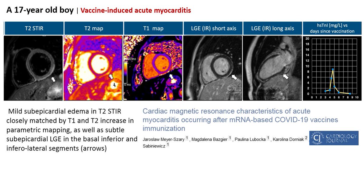 DrJohnB2's tweet photo. A 17-year old boy
- 1 day after the #CovidVaccine (Pfizer-BioNTech): severe stabbing chest pain & fever
⇒ Myocarditis
https://t.co/EPMD0Mqwvh https://t.co/E9rPLbARuM
