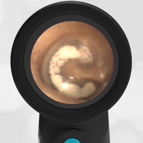 WiscMedWispr's tweet photo. Myringosclerosis https://t.co/Qb0AJAtcYT #Myringosclerosis #Peds #otolaryngology #pediatrics #ERPeds #Physician #eardrum #Tympanic #digitalotoscope #WiscMed #Wispr https://t.co/8QKBIkwbo7