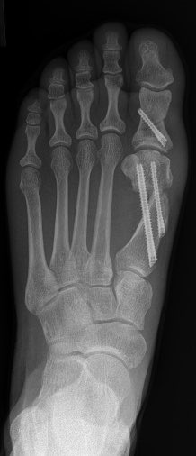 MIS hallux valgus correction has made bunions fun to fix because of better patient satisfaction, better range of motion and faster recovery. This patient has no pain in a sneaker at 6 weeks post-op.