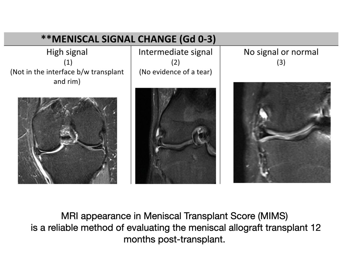 KSSTA's tweet photo. This study identified meniscal extrusion, signal changes, loss of shape, synovitis and bone marrow oedema to be important parameters in assessing meniscal appearance post MAT.
@TimSpaldingKnee
#Meniscaltransplant #Knee #Meniscus #allograft #MRIimaging
https://t.co/luOVdHJykb https://t.co/udktF8t54M