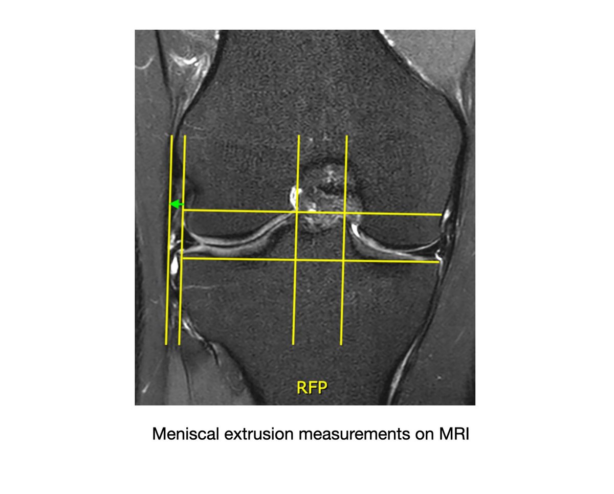 KSSTA's tweet photo. This study identified meniscal extrusion, signal changes, loss of shape, synovitis and bone marrow oedema to be important parameters in assessing meniscal appearance post MAT.
@TimSpaldingKnee
#Meniscaltransplant #Knee #Meniscus #allograft #MRIimaging
https://t.co/luOVdHJykb https://t.co/udktF8t54M
