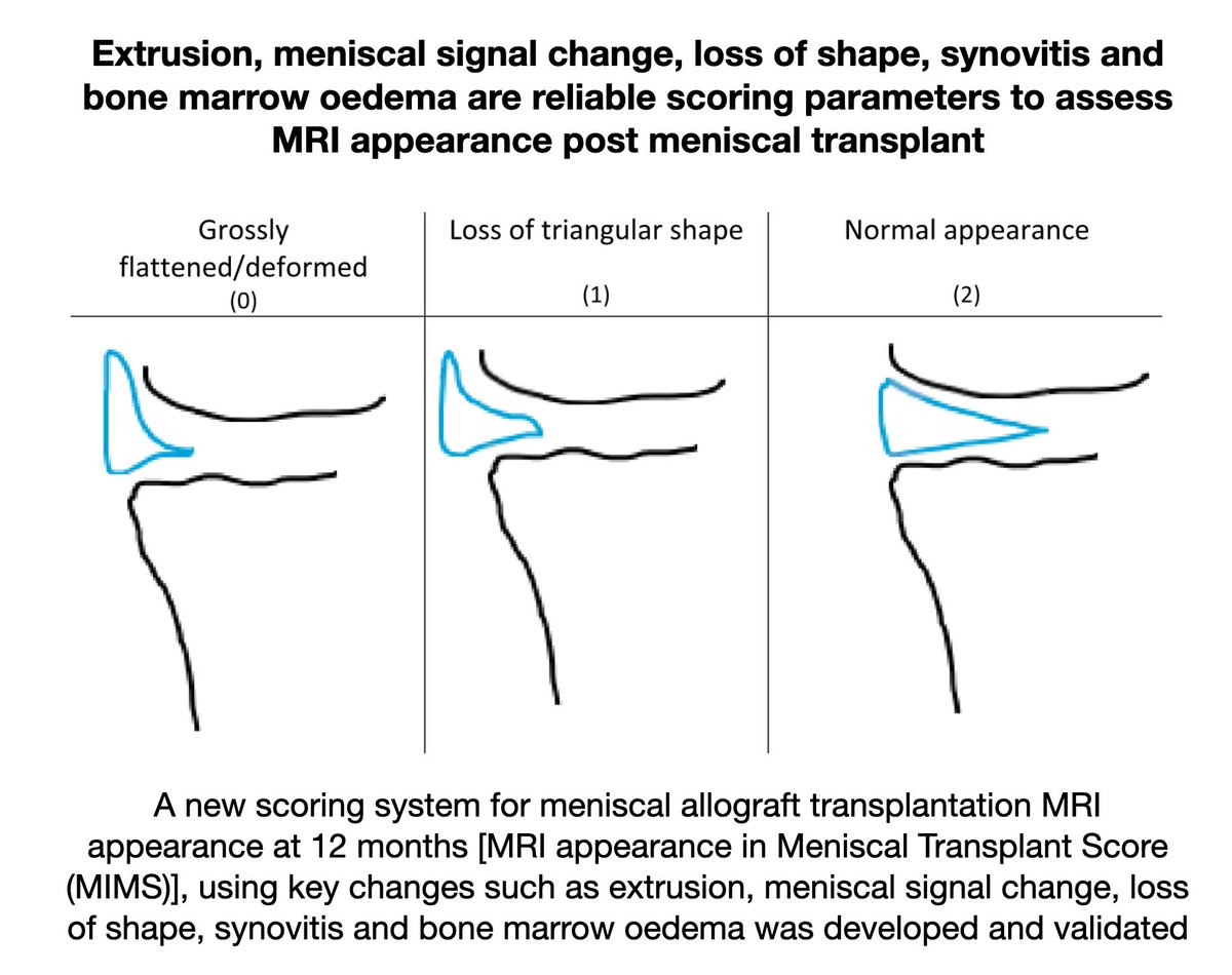 KSSTA's tweet photo. This study identified meniscal extrusion, signal changes, loss of shape, synovitis and bone marrow oedema to be important parameters in assessing meniscal appearance post MAT.
@TimSpaldingKnee
#Meniscaltransplant #Knee #Meniscus #allograft #MRIimaging
https://t.co/luOVdHJykb https://t.co/udktF8t54M