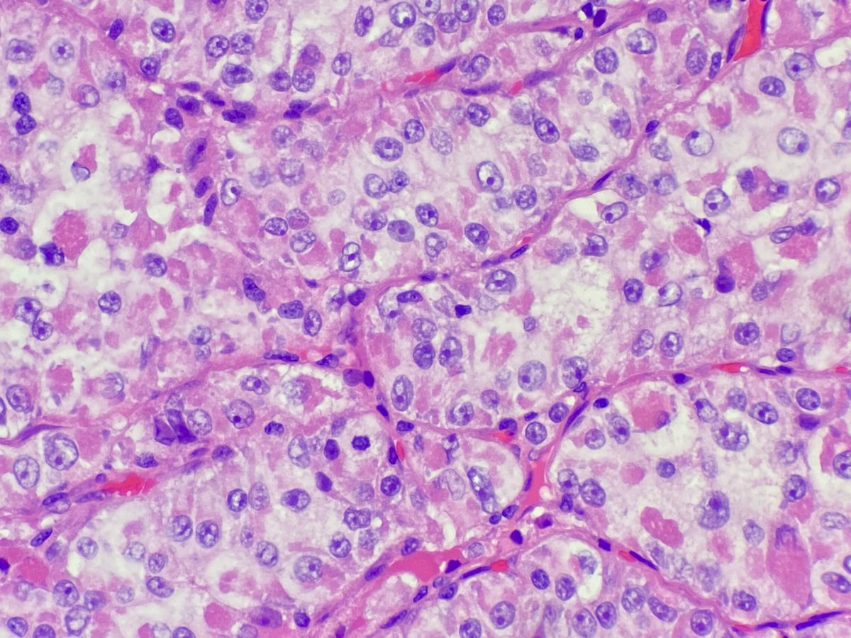 JCloutierMD's tweet photo. One of the most histologically distinctive soft tissue tumors. 

Alveolar soft part sarcoma. 

Diffuse TFE3 expression by IHC. 

#BSTpath #sarcoma https://t.co/Y74FKGYHH6