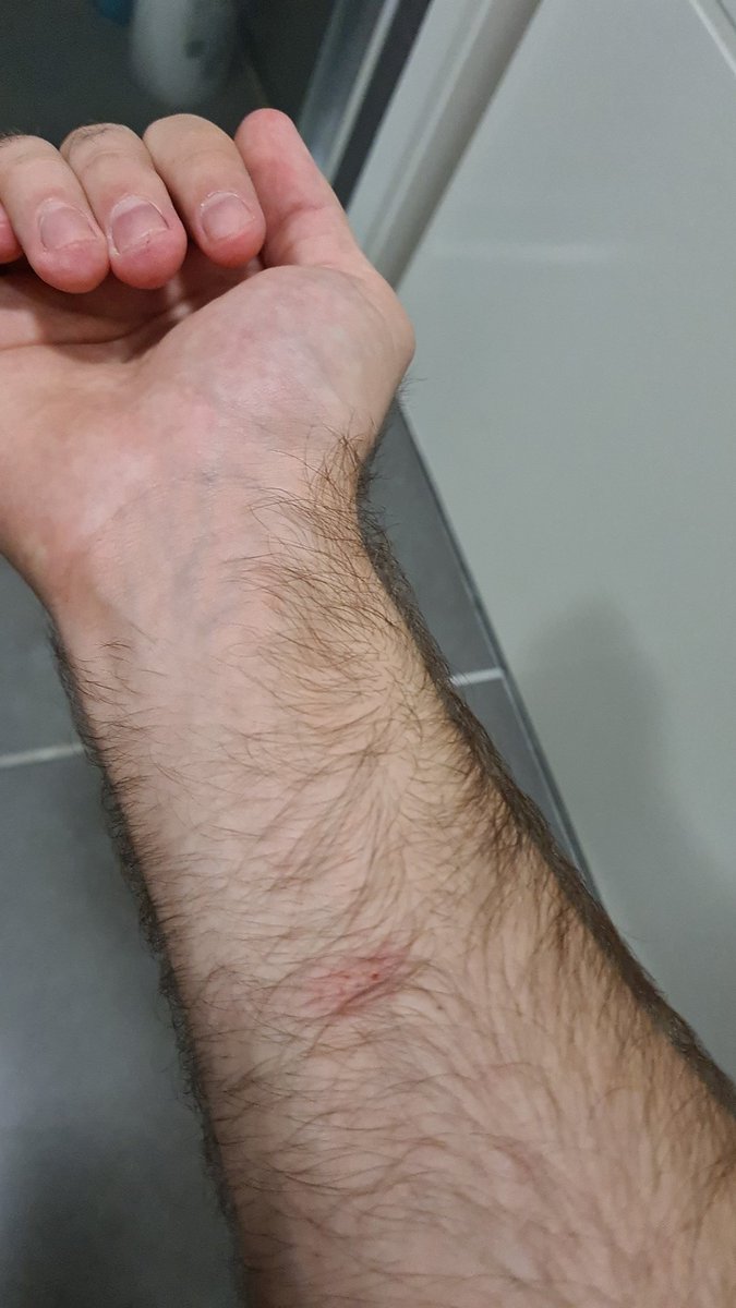 pierceyb0y's tweet photo. See other continents... Tis proof that you can get bit by a spider and not need to goto the hospital....

As long as you know what spider bit you 😰

I probably wont die right? https://t.co/Kh5pYcDWt1