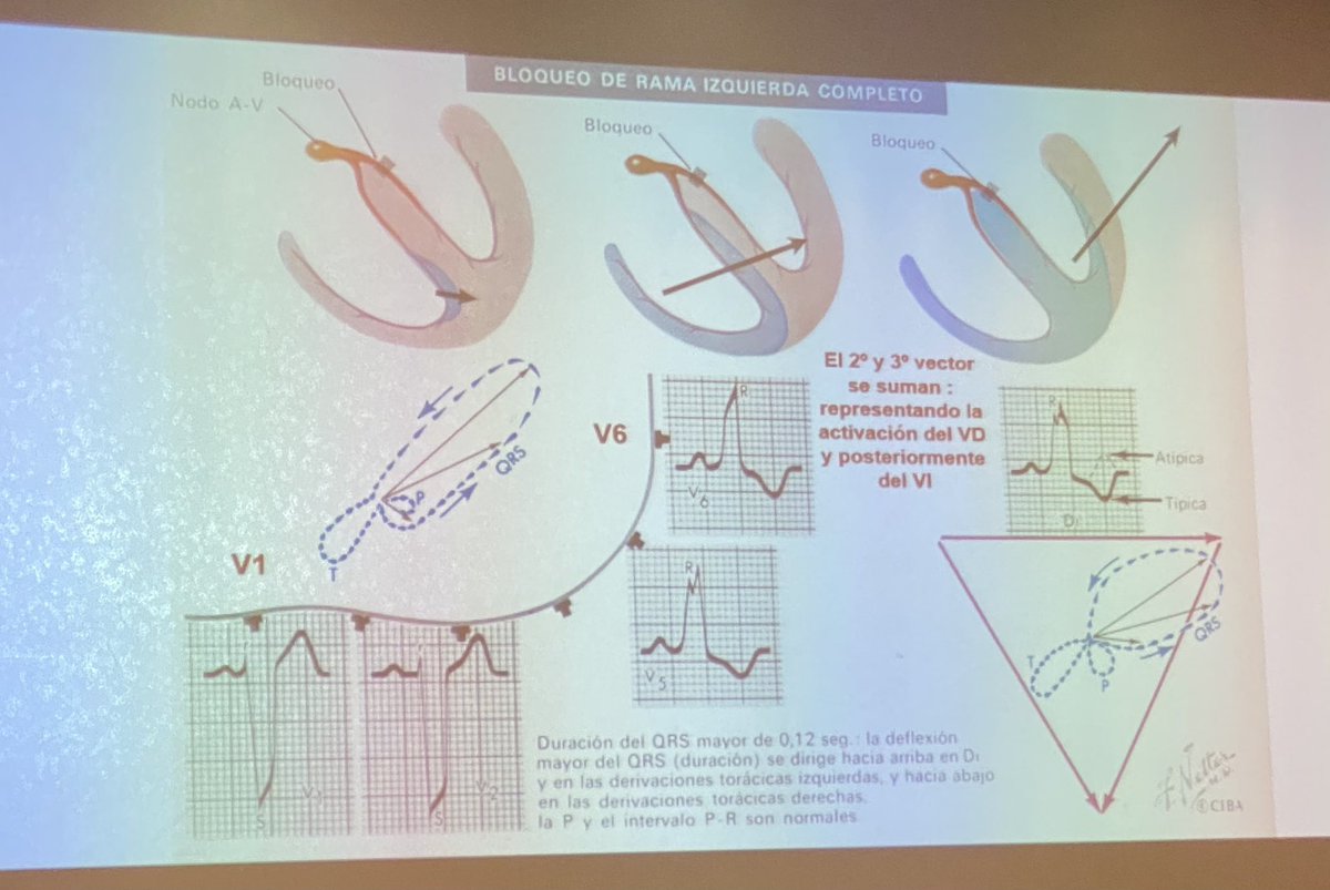 Juan_PeiroM's tweet photo. 3 Jornadas Residentes #MFyC 

MICROPÍLDORAS 

¿Qué cosas no debe olvidar un residente al revisar un #ekg?
🧐🧐🤔🤔🤓🤓

Dr. Miquel Fiol.
Cardiólogo 

@ibsemergen @SEMERGEN_MIR @SEMERGENap #JornadasIB21 @apmallorca @COMbalears @juanedahosp 
@SAMU061IB @almucastro01 
@mbeyp2 https://t.co/mCbIqNC7j6