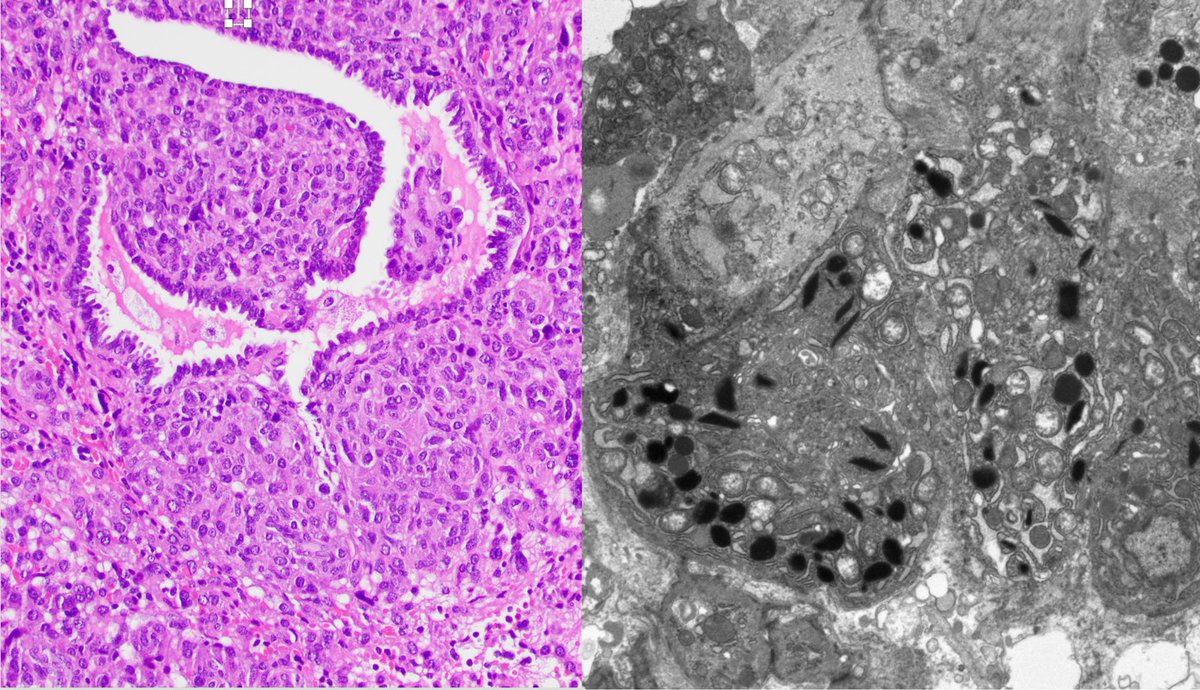 Case 5
Reninoma/Juxtaglomerular cell tumor. Neoplasm of renin-secreting cells. Renin+, vimentin+, CD34+, and CD117+. Electron microscopy shows rhomboid crystals of renin protogranules.