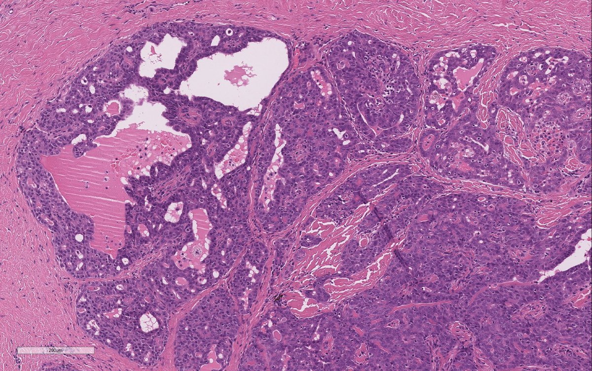 WeinrebIlan's tweet photo. Tracheal tumour. 

Thoughts? https://t.co/LRO4MJG20z