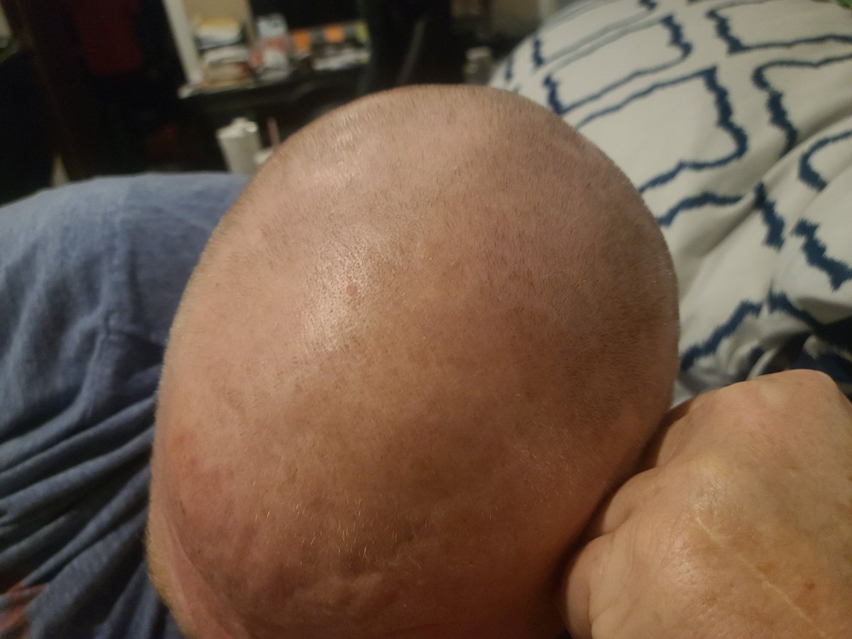 AndyJuels's tweet photo. @MrZackMorris completed my stem cell transplant. Sick as hell, but getting better.  Lost all hair in 3 days!  Thanks for Everything! https://t.co/EDUtKgVWJf