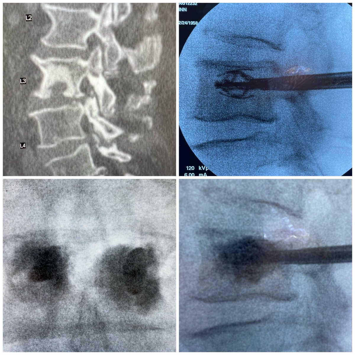 pascalzinn's tweet photo. Thanks to Duane ⁦@StrykerNS⁩ ⁦@TheStrykerIVS⁩ and ⁦@PittNeurosurg⁩ residents for great #spine #jack case! ⁦@UPMCHillmanCC⁩ https://t.co/pRyDmGd3s9