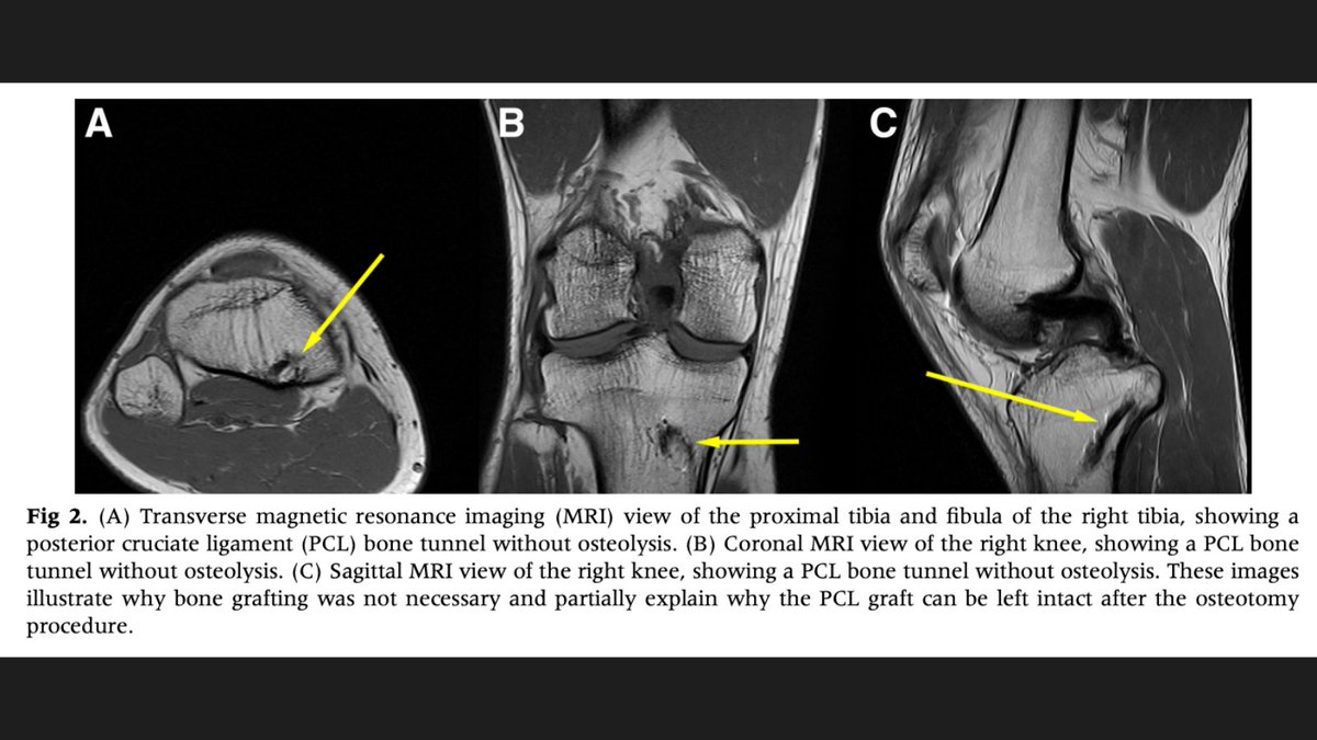thekneedoc's tweet image. NEW DR. LAPRADE STUDY! 

Proximal Tibial Opening Wedge #Osteotomy for the Treatment of Posterior #KneeInstability and Genu Recurvatum Secondary to Increased Anterior Tibial Slope. Here are the findings: medilink.us/w80i #medtwitter #sportsmedicine #orthotwitter