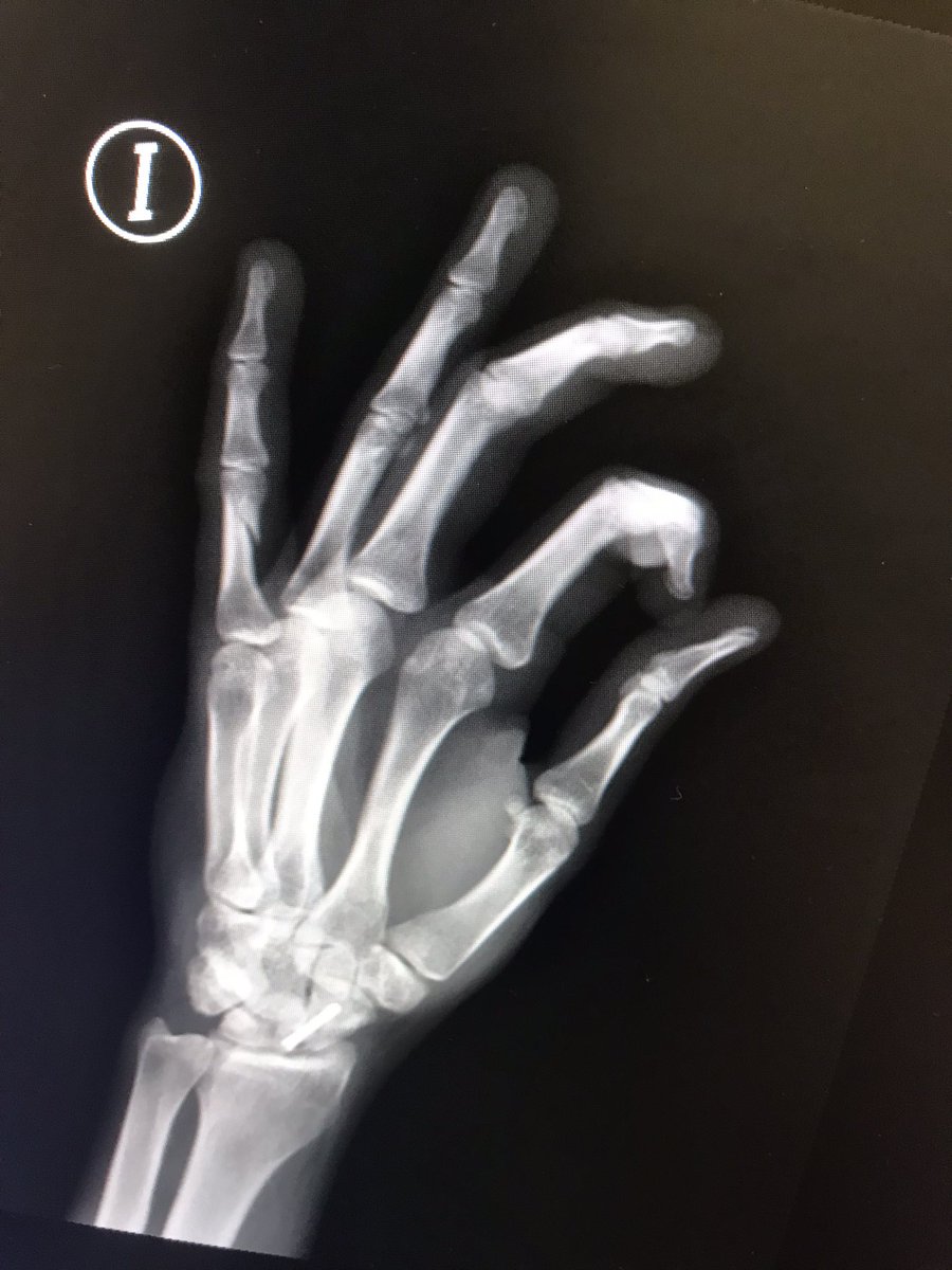 RX_SALUD's tweet photo. #Paciente que Se ha pillado el dedo con la puerta del coche…se realiza #radiografía Ap, y L de la mano…
.
#Radiología #Radiology #Radspain #RadiologiaSalud #Traumatología #Traumatology https://t.co/1bdpeFxZpC