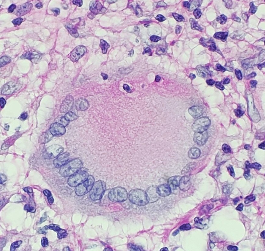 DraEosina's tweet photo. Langhans giant cell says HAPPY FRIDAY!
#Pathology #pathreidolia https://t.co/M9n51EUD0n