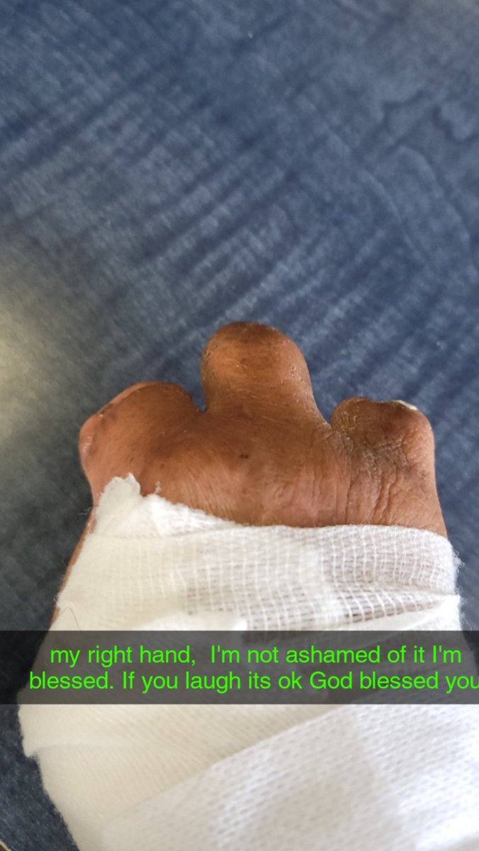 mysonear's tweet photo. my right hand I'm not ashamed of it I'm blessed,. if you laugh its ok God bless you.  dodgers for life https://t.co/snIQvGWLkO