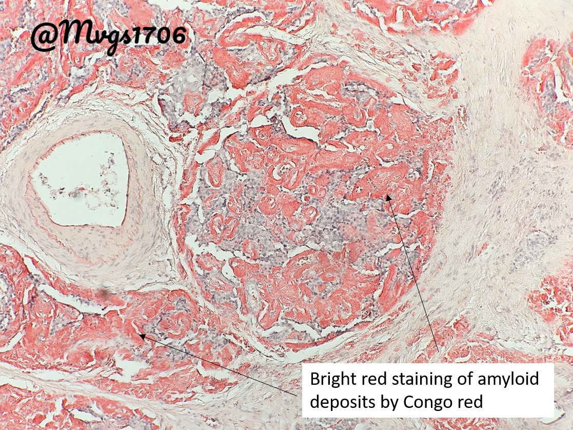 Mvgs1706's tweet photo. This pancreatic neuroendocrine tumors (panNET) really went overboard with it's amyloid!
Scroll down for some fun questions to test your amyloid and panNET knowledge!
#pancreas #pancpath #neuroendocrine #pathboards https://t.co/kxOZTCWKij