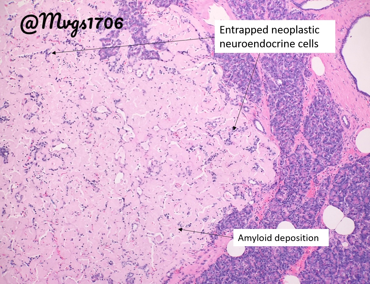 Mvgs1706's tweet photo. This pancreatic neuroendocrine tumors (panNET) really went overboard with it's amyloid!
Scroll down for some fun questions to test your amyloid and panNET knowledge!
#pancreas #pancpath #neuroendocrine #pathboards https://t.co/kxOZTCWKij