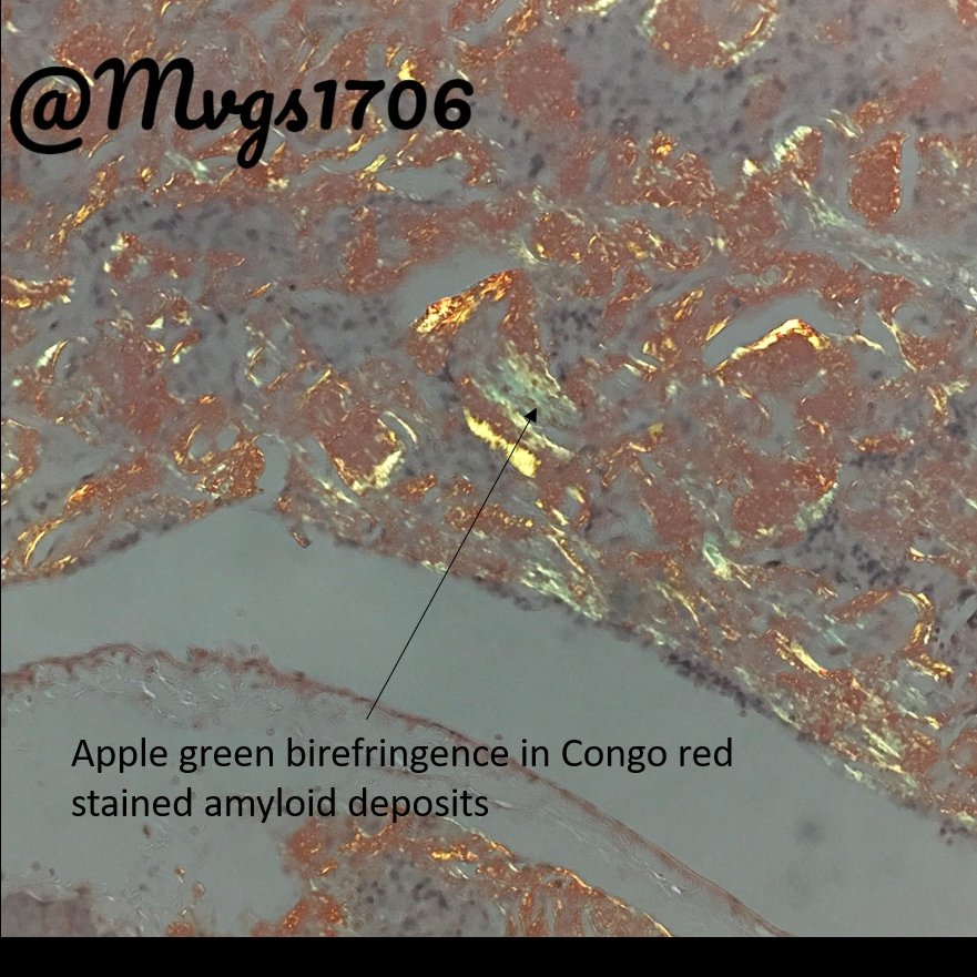 Mvgs1706's tweet photo. This pancreatic neuroendocrine tumors (panNET) really went overboard with it's amyloid!
Scroll down for some fun questions to test your amyloid and panNET knowledge!
#pancreas #pancpath #neuroendocrine #pathboards https://t.co/kxOZTCWKij