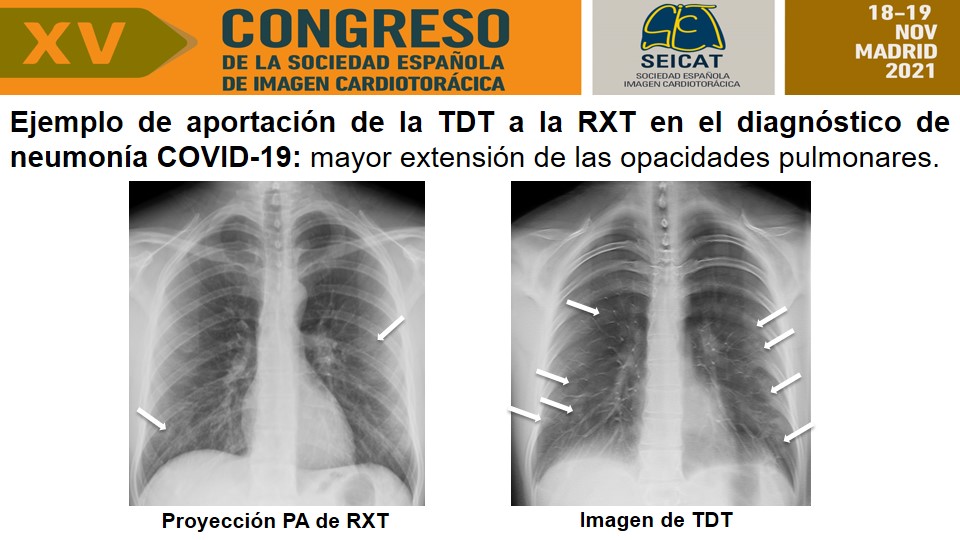 serammeA6SALUD's tweet photo. La tomosíntesis torácica digital 3D aporta datos clínicos relevantes hasta en el 20% de pacientes con COVID-19 cuando la Rx de tórax es valorada por radiólogos expertos. Resultados presentados en una comunicación oral @serammeA6SALUD en el XV Congreso de la #SEICAT @SEICAT_RAD https://t.co/QPWcfBGAAC
