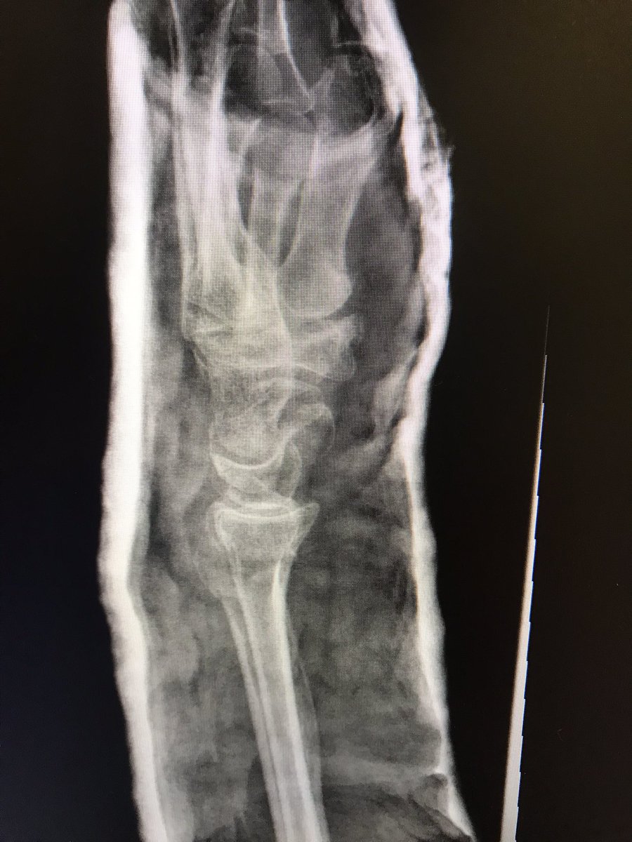 RX_SALUD's tweet photo. #Paciente de edad avanzada, que Se ha caído, y este es el resultado del Antes , y después de la #escayola en la muñeca
.
#Radiología #Radiology #Radspain #RadiologiaSalud #Traumatología #Traumatology #tsid #ter https://t.co/AL9O8KA89P