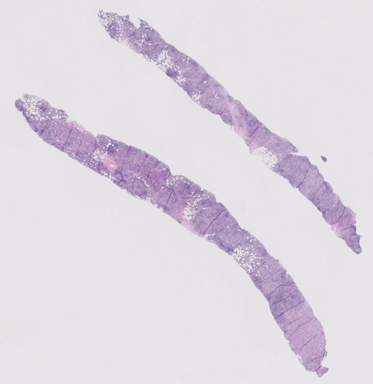VickeryJasmine's tweet photo. Happy Friday! Breast core needle biopsy, let me know what you think it is #PathTwitter #pathology   #BreastPath #hemepath @UChicagoPath https://t.co/yMy2iUakUS