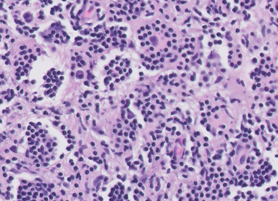 VickeryJasmine's tweet photo. Happy Friday! Breast core needle biopsy, let me know what you think it is #PathTwitter #pathology   #BreastPath #hemepath @UChicagoPath https://t.co/yMy2iUakUS