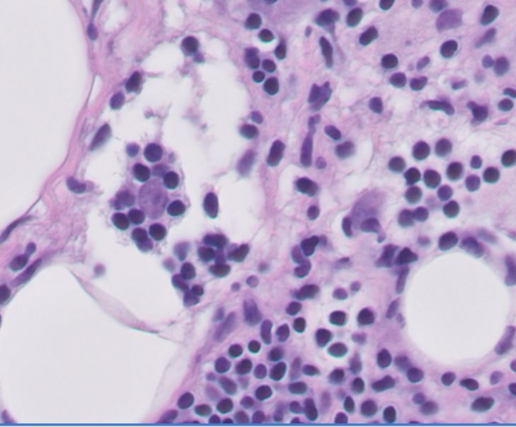 Happy Friday! Breast core needle biopsy, let me know what you think it is #PathTwitter #pathology   #BreastPath #hemepath <a href="/UChicagoPath/">University of Chicago Pathology</a>