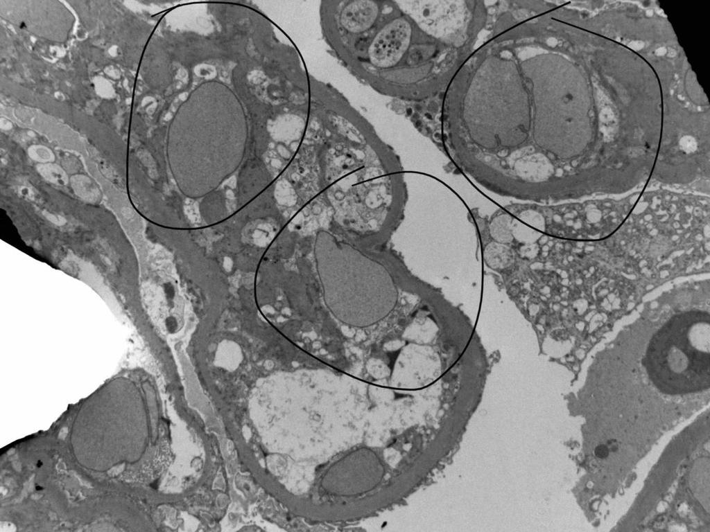 BuddingLiska's tweet photo. For diagnostic assistance: an 18 year old male with diabetes mellitus type 1. Endocapillary proliferative glomerulonephritis with crescents. Any ideas would be appreciated 😊 @christiestwit 

#PathTwitter #renalpath #pathology #NephTwitter #nephrology https://t.co/eGNWbnsQpy