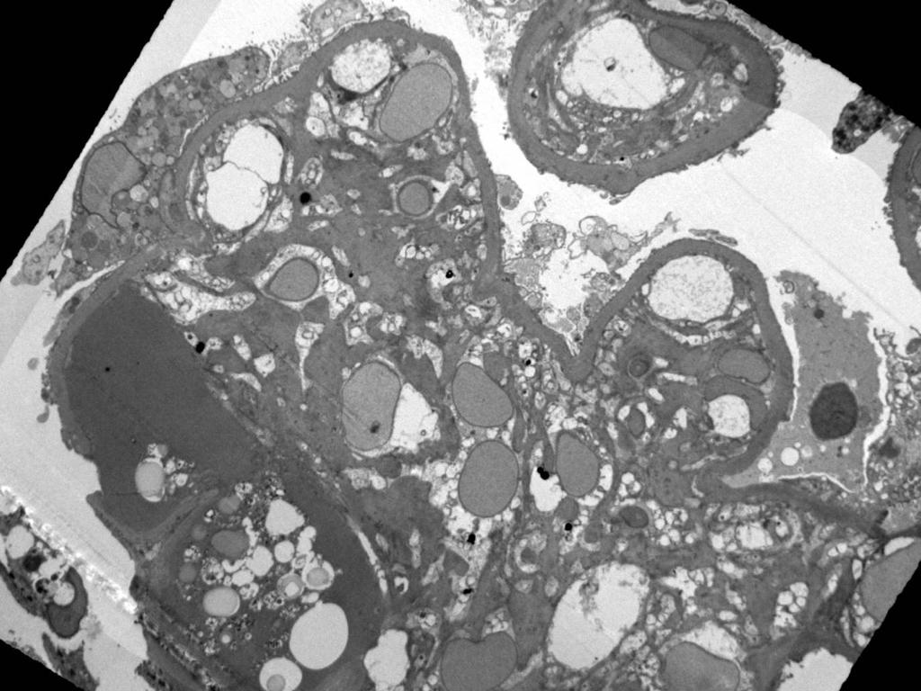 BuddingLiska's tweet photo. For diagnostic assistance: an 18 year old male with diabetes mellitus type 1. Endocapillary proliferative glomerulonephritis with crescents. Any ideas would be appreciated 😊 @christiestwit 

#PathTwitter #renalpath #pathology #NephTwitter #nephrology https://t.co/eGNWbnsQpy